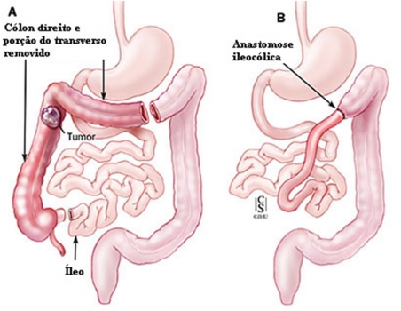 Intestino grosso (reto e c�lon)